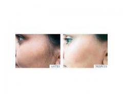 PRECIOS!!!-Cejas superior/inferior y entrecejo....