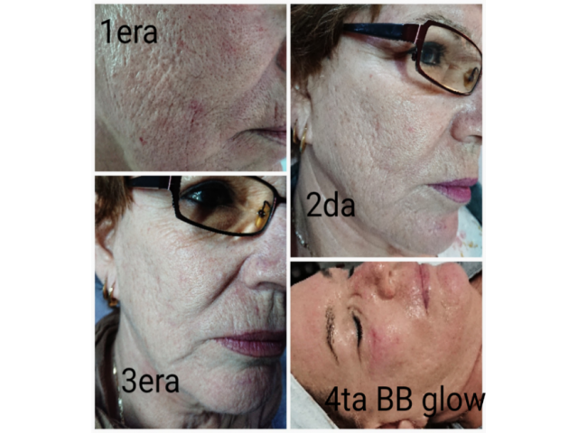 Y&Y Estética BB Glow, Dermapen, microneedle, fototerapia, mesoterapia
