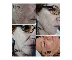 Y&Y Estética BB Glow, Dermapen, microneedle, fototerapia, mesoterapia